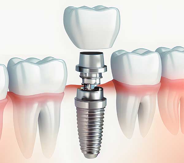 インプラント治療とはどのようなものか